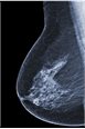 breast-cancer-bitesize