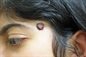 Kaposi's Sarcoma