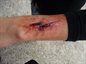 Old cut to arm