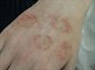 Eczema