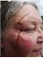 Healed Facial Disfigurement