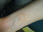 Ringworm