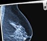 Radiotherapy between or during chemotherapy cycles reduces risk of breast cancer recurrence