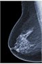 Birmingham Fellow developing new treatment for breast cancer