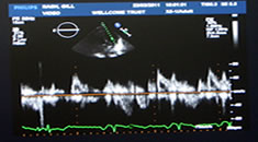 Heart ultrasound image