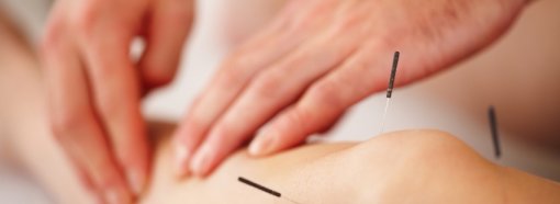 Acupuncture