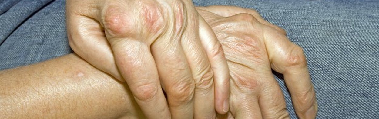 Rheumatoid Arthritis: the Public InformeD (RAPID)