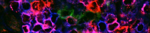 Hodgkin's lymphoma with H-RS Cells (green) and CXCR3 positive T cells (pink)
