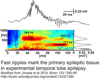 Fast ripples in epilepsy