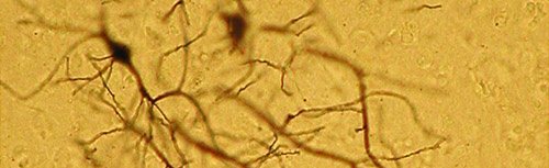 2nd-tier-Neurodegeneration-picture-V1
