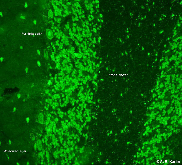 Paraneoplastic neurological antibodies University of Birmingham