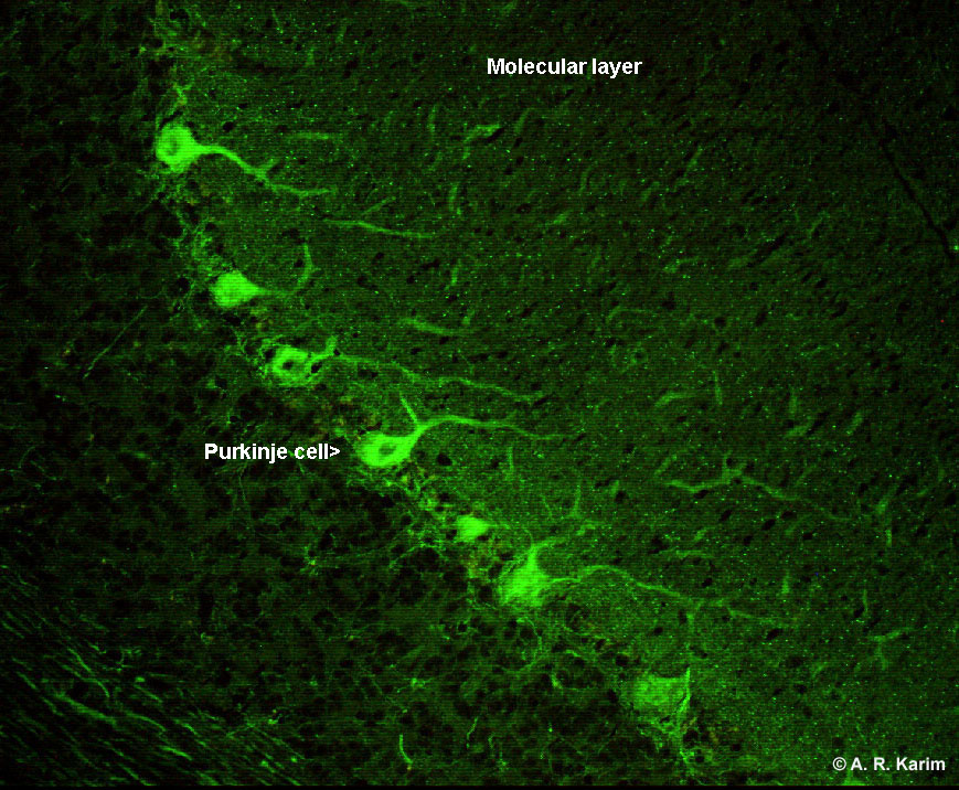 Paraneoplastic neurological antibodies University of Birmingham