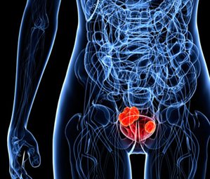 bladder-cancer-cropped