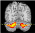 Miall mri imaging