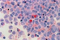 Acute myeloid leukemia cells as seen under a microscope