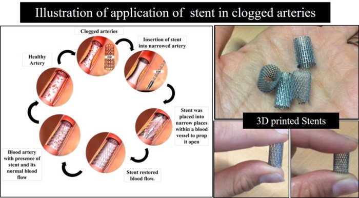 Illustration of stent in clogged arteries