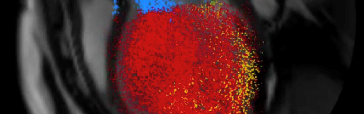 Tracking the blood in the heart using cardiac MRI