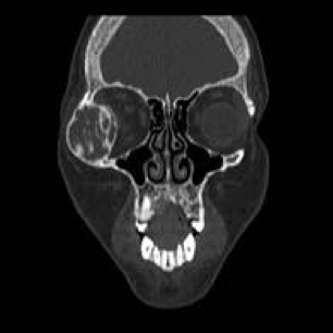 CT scan showing brown tumour in lateral wall or orbit in patient with primary hyperparathyroidism