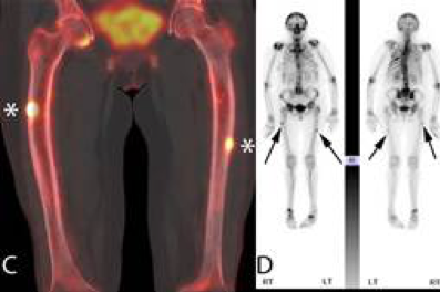 Isotope bone scan and overlay SPECT-CT showing bilateral unicortical incomplete femoral fractures related to prolonged bisphosphonate therapy