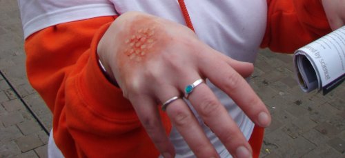 prosthetic smallpox on girl's hand