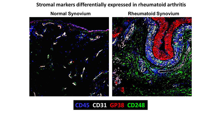 Stromal markers differentially expressed in rheumatoid arthritis. Normal Synovium and Rheumatoid Synovium. CD45, CD31, CP38 and CD248