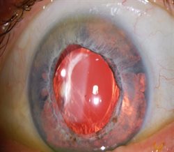 Close-up image of human eye displaying uveitis