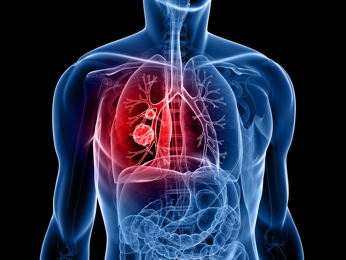 Lung cancer image