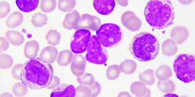 leukaemia cells_web