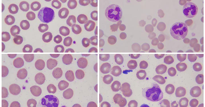 Human blood cells under a midcroscope