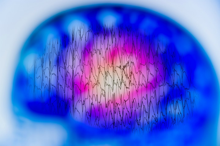 EEG from an epilepsy patient
