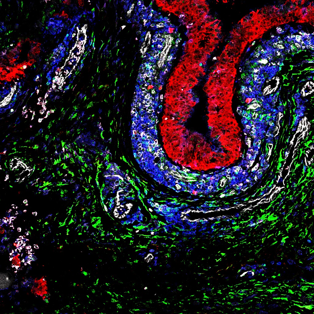 Synovial Fibroblasts (SFs) - pictured below - are cells that make up part of the connective tissue, or synovium, around human joints. In RA patients, SF cells cause damage by invading and attacking the cartilage and bone around the joint.