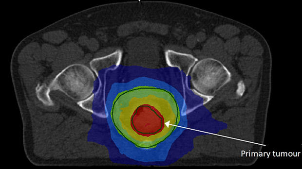 CT scan showing a rectal tumour.