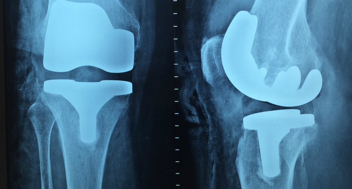 x-ray of a replacement joint