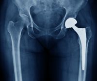 The material has distinct advantages for bone and joint replacements