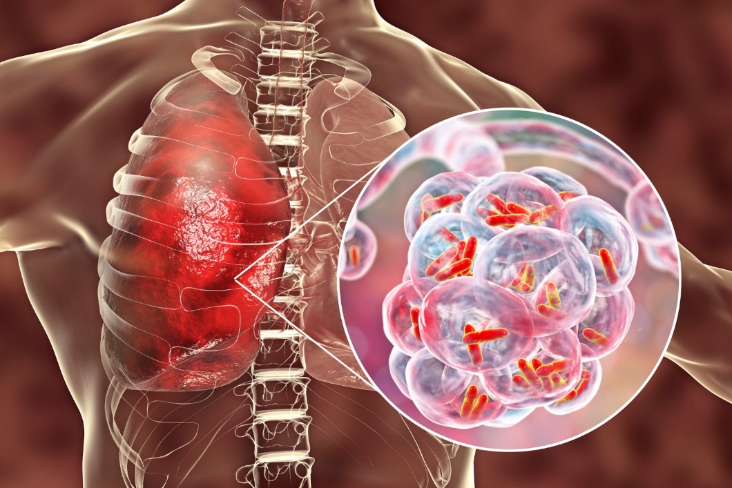 Tuberculosis bacteria in the lung