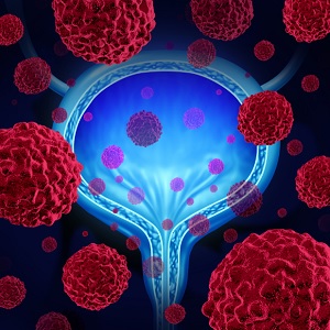 cancer cells in human bladder
