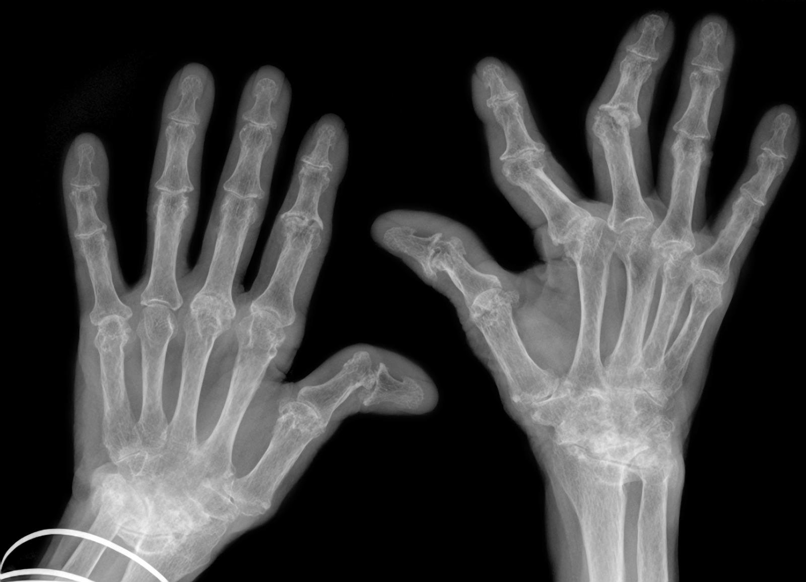 University of Birmingham forms spinout to develop new therapeutic