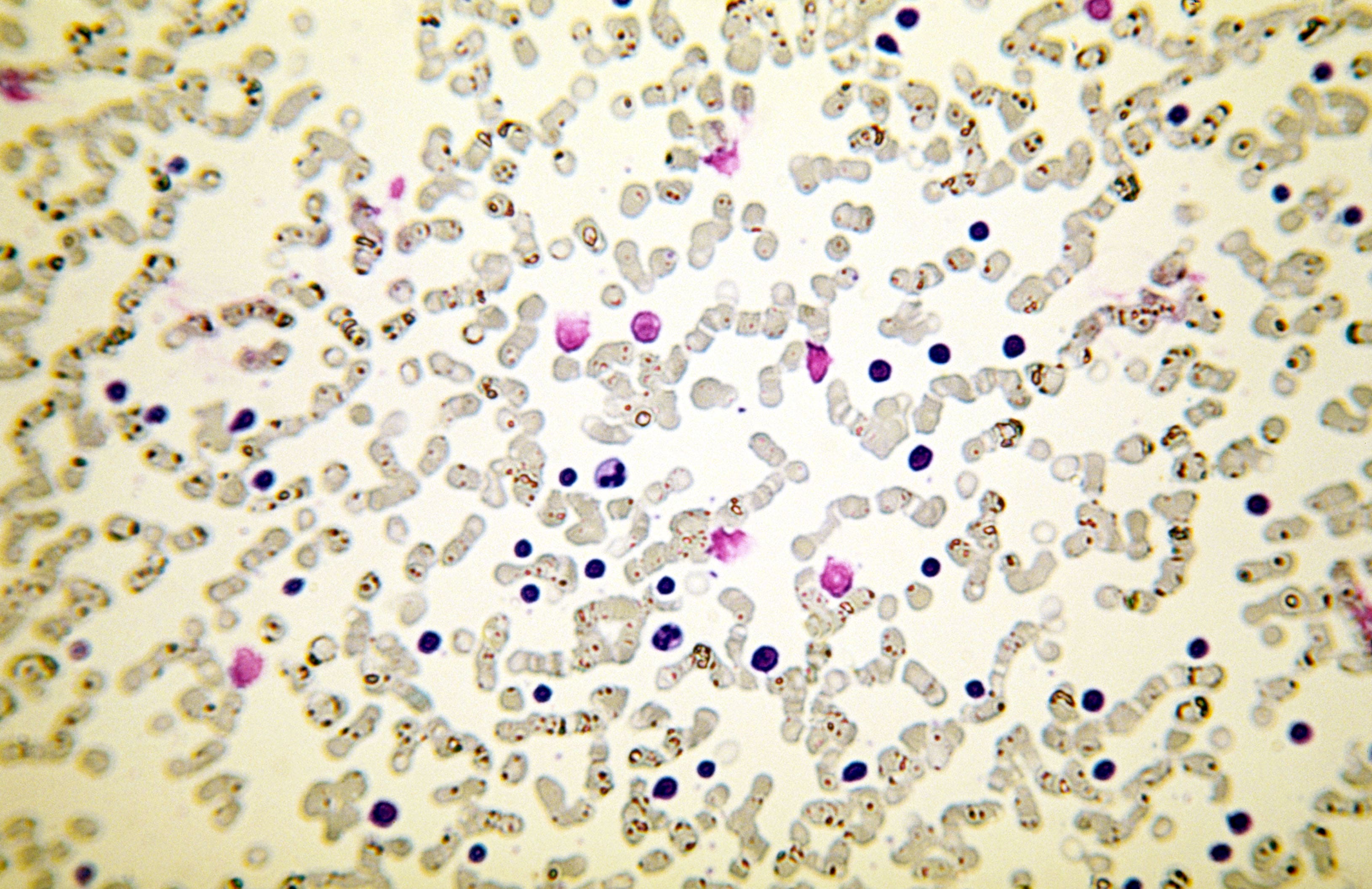 Smudge cells in peripheral blood