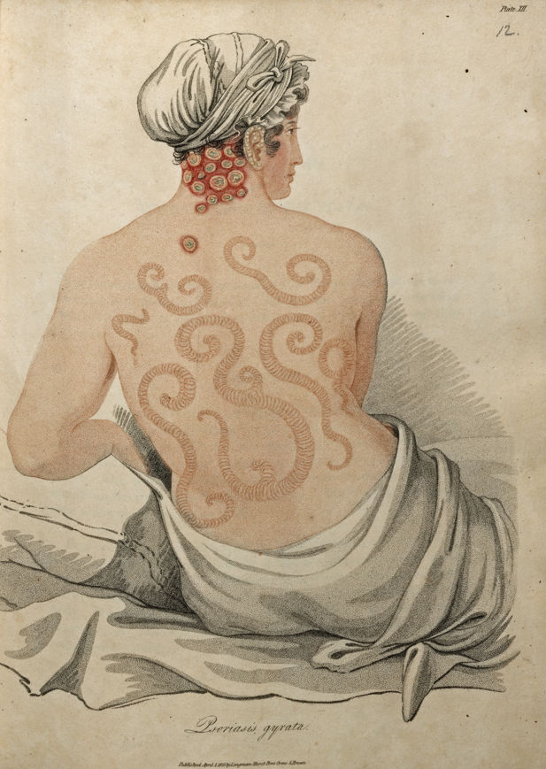 Psoriosis, Bateman 1828, Cadbury Research Library