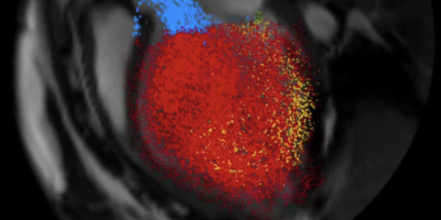Tracking the blood in the heart using cardiac MRI