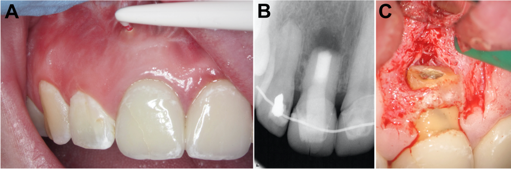 Clinical case showing failure of surgical endodontic therapy; the material at the root-end was retrieved and characterized. The formation of calcium carbonate on the material surface was evident as shown in the X-ray diffractogram.