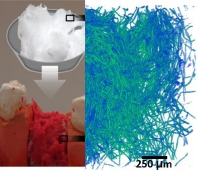 Electrospun bioactive glass fibres for bone regeneration.