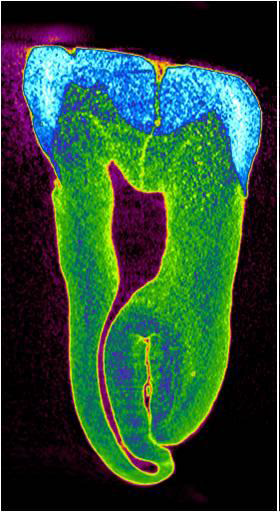 CT scan of a tooth.
