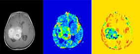 Conventional MRI scan of a tumour on the left. MRI with a contrast agent shows a high blood volume in the centre image. After correction, the image on the right shows a high level of leakiness, which this study demonstrated is a feature associated with aggressive tumours.