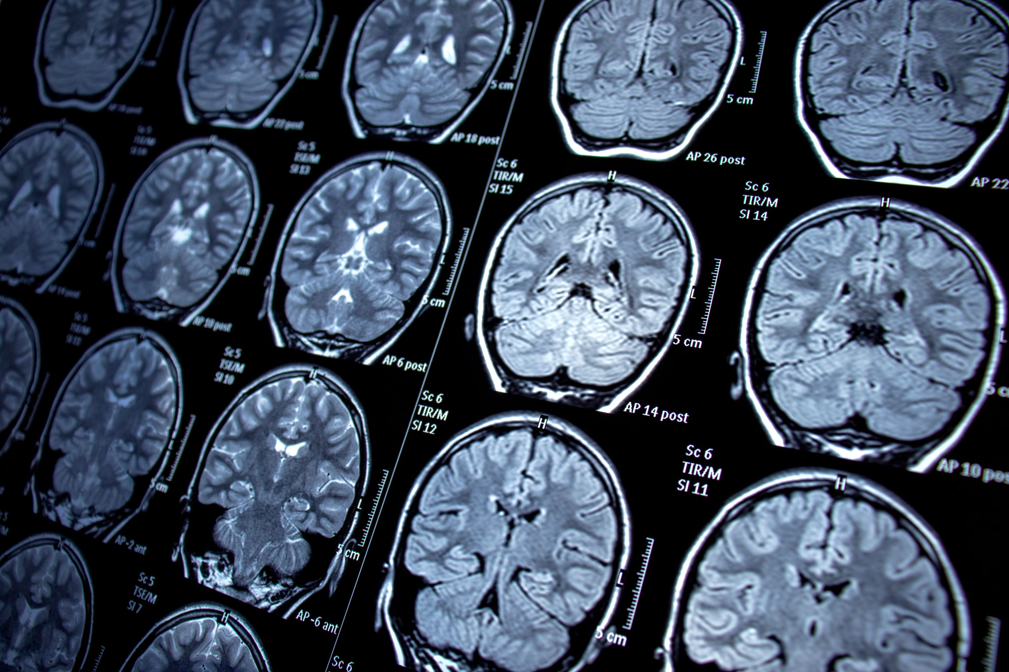 xray of a brain