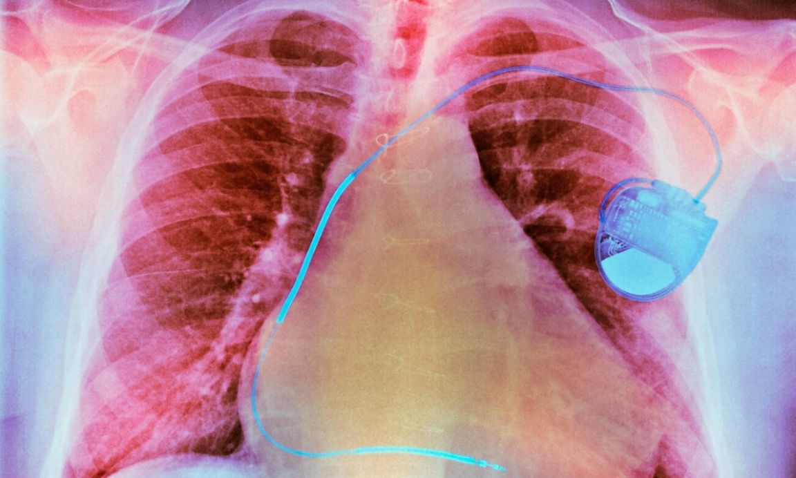 Coloured chest X-ray showing a pacemaker fitted to a patient with an enlarged heart