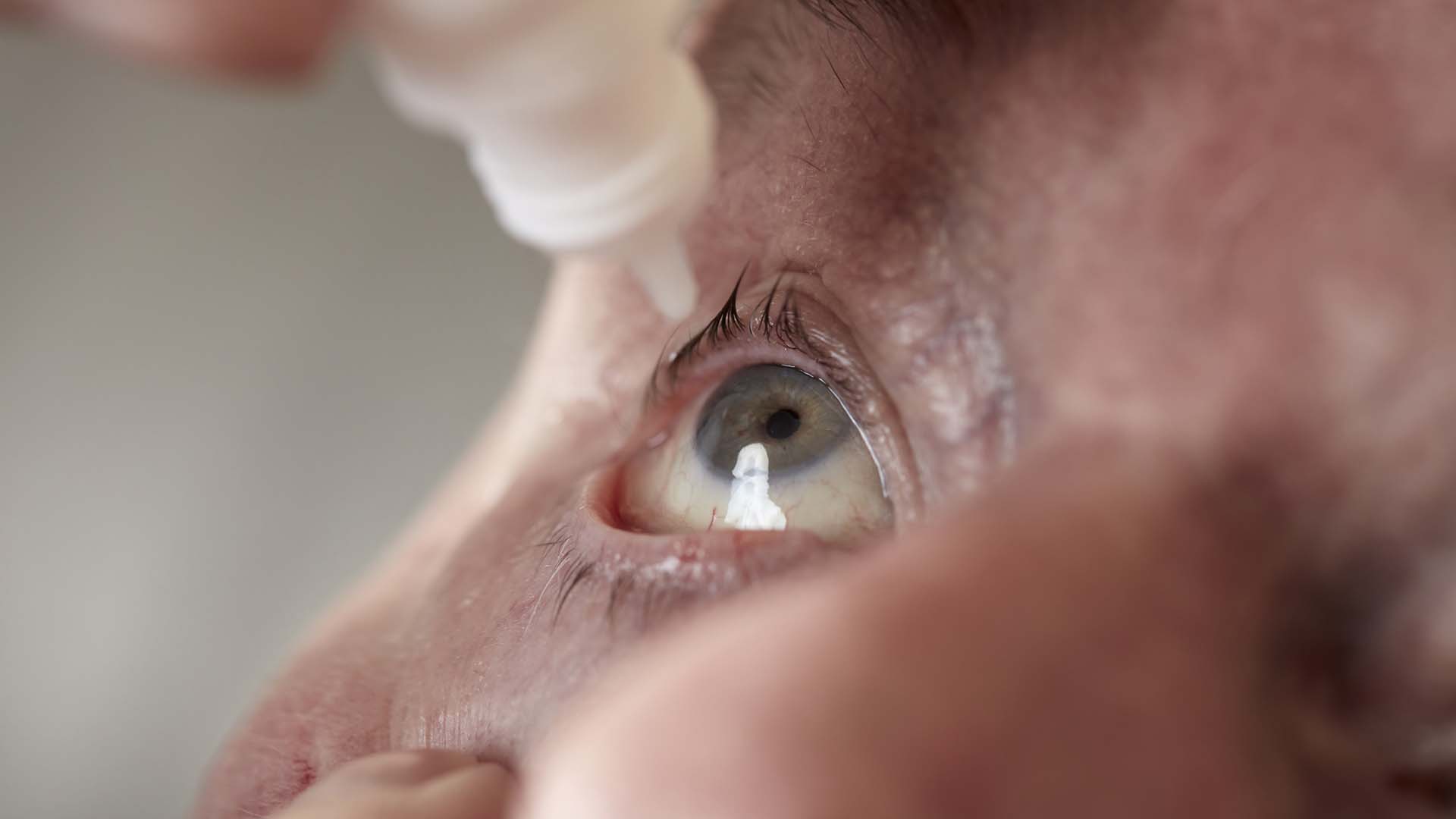 Close-up of eyedrops being administered into a male patient's right eye