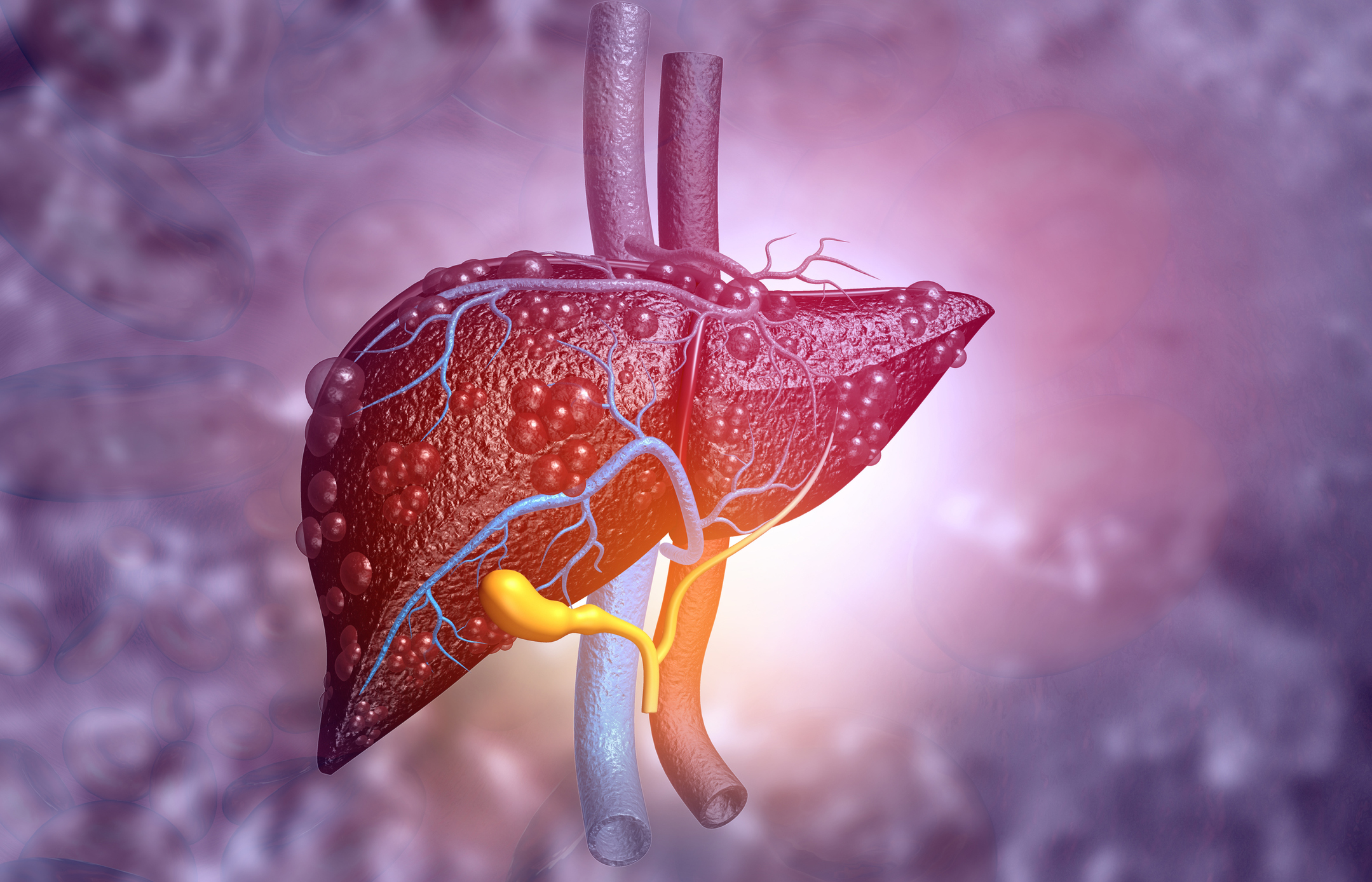 3D illustration of diseased liver