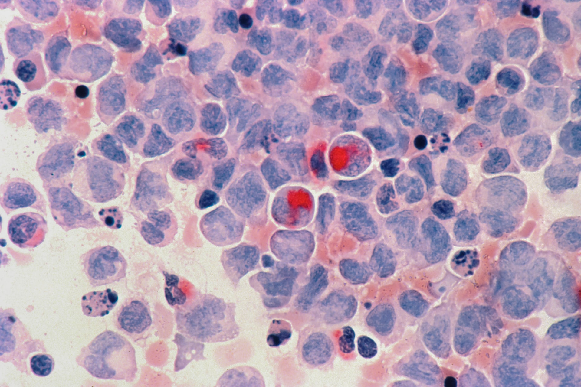 Illustration of microscopic blood cancer cells 