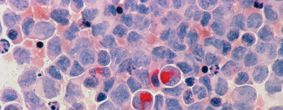 Illustration of microscopic leukemia cancer cells 